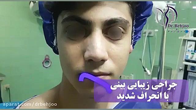 فیلم واقعی جراحی بینی مردانه دکتر شاهین بهجو - فوق تخصص جراحی پلاستیک