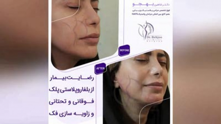 فیلم رضایتمندی بیمار از عمل بلفاروپلاستی و زاویه سازی فک دکتر شاهین بهجو - فوق تخصص جراحی پلاستیک