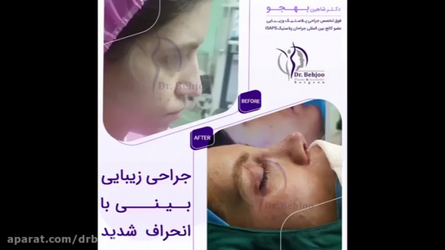 فیلم واقعی جراحی بینی با انحراف شدید دکتر شاهین بهجو - فوق تخصص جراحی پلاستیک