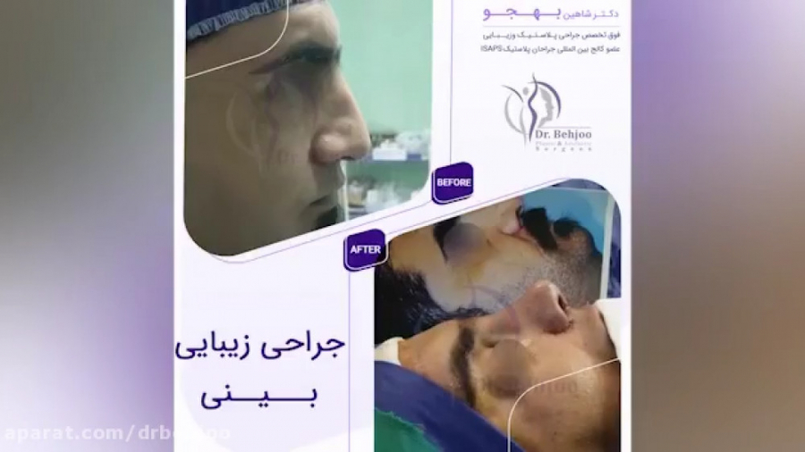 فیلم واقعی جراحی زیبایی بینی مردانه دکتر شاهین بهجو - فوق تخصص جراحی پلاستیک