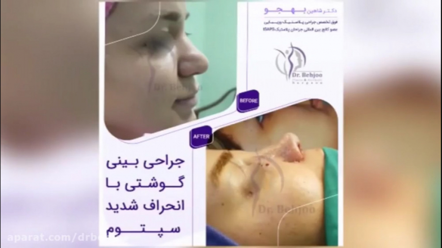 فیلم واقعی جراحی بینی گوشتی با انحراف شدید دکتر شاهین بهجو - فوق تخصص جراحی پلاستیک