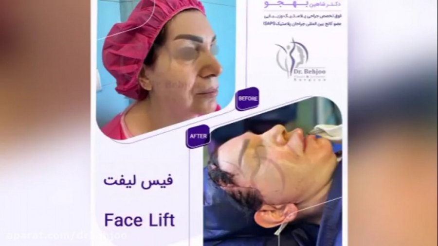 فیلم واقعی جراحی فیس لیفت در اتاق عمل دکتر شاهین بهجو - فوق تخصص جراحی پلاستیک