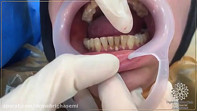 درمان جرمگیری دندان | کلینیک دندانپزشکی دیجیتال دکتر مهری قاسمی کلینیک پوست
