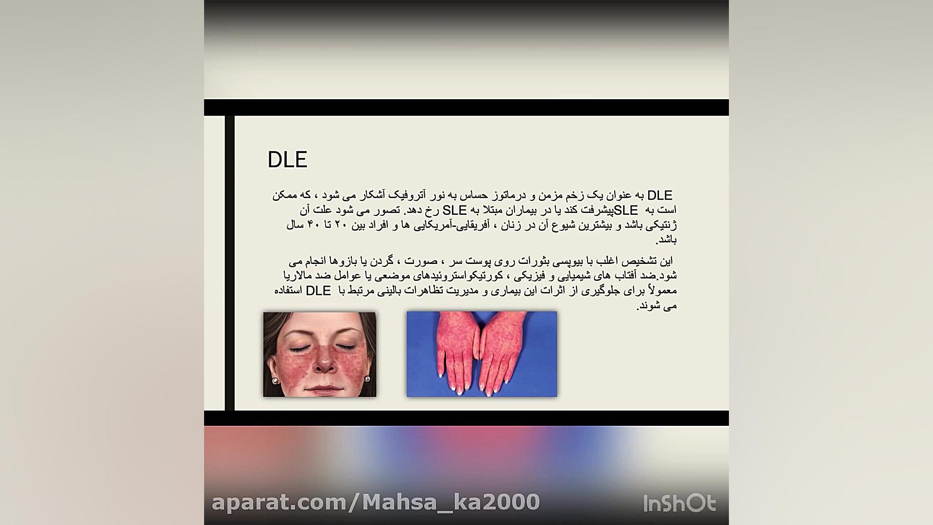لوپوس لیپوست
