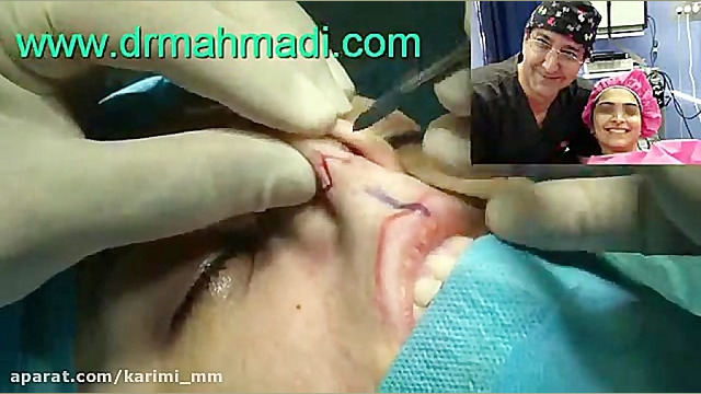 جراحی زیبایی بینی(rhinoplasty)توسط متخصص گوش وحلق بینی دکتر مهدی احمدی