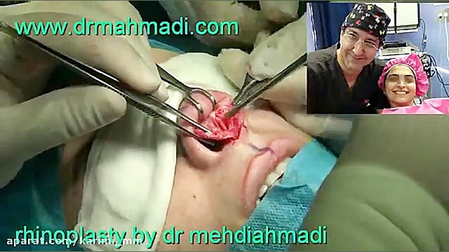 عمل زیبایی بینی(rhinoplasty)توسط متخصص گوش وحلق بینی2 دکتر مهدی احمدی