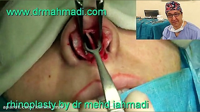 عمل زیبایی بینی(rhinoplasty)توسط متخصص گوش وحلق بینی3 دکتر مهدی احمدی