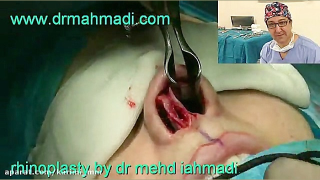 عمل زیبایی بینی(rhinoplasty)توسط متخصص گوش وحلق بینی5 دکتر مهدی احمدی