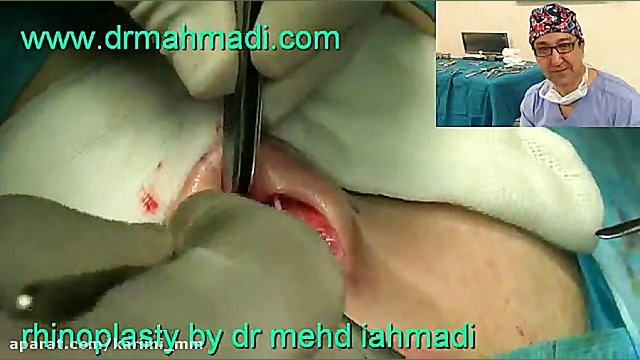 عمل زیبایی بینی(rhinoplasty)توسط متخصص گوش وحلق بینی6 دکتر مهدی احمدی
