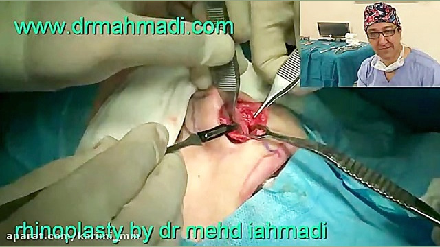 عمل زیبایی بینی(rhinoplasty)توسط متخصص گوش وحلق بینی7 دکتر مهدی احمدی