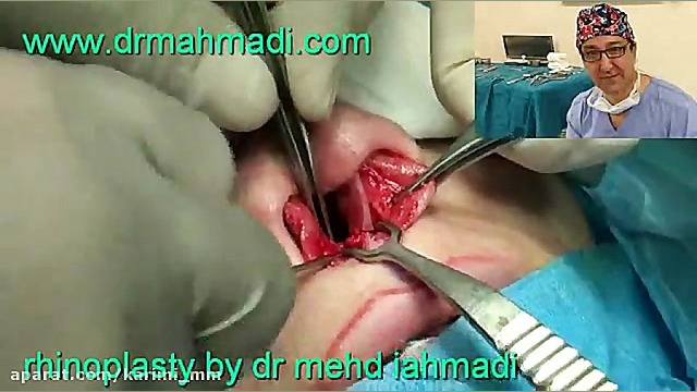 عمل زیبایی بینی(rhinoplasty)توسط متخصص گوش وحلق بینی9 دکتر مهدی احمدی