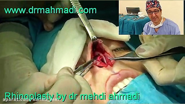 عمل زیبایی بینی(rhinoplasty)توسط متخصص گوش وحلق بینی10 دکتر مهدی احمدی