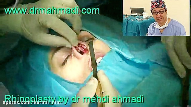 عمل زیبایی بینی(rhinoplasty)توسط متخصص گوش وحلق بینی11 دکتر مهدی احمدی