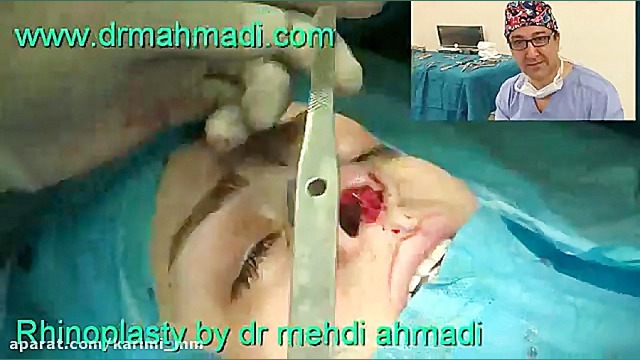 عمل زیبایی بینی(rhinoplasty)توسط متخصص گوش وحلق بینی17 دکتر مهدی احمدی