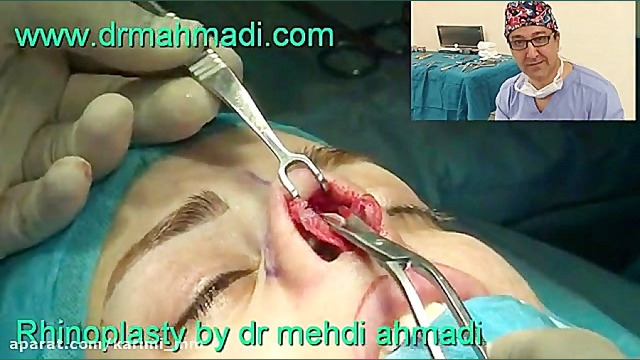 عمل زیبایی بینی(rhinoplasty)توسط متخصص گوش وحلق بینی19 دکتر مهدی احمدی