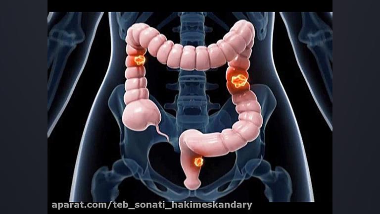 پیشگیری از سرطان روده بزرگ در طب سنتی با گیاهان دارویی ترمیم زیبایی دندان