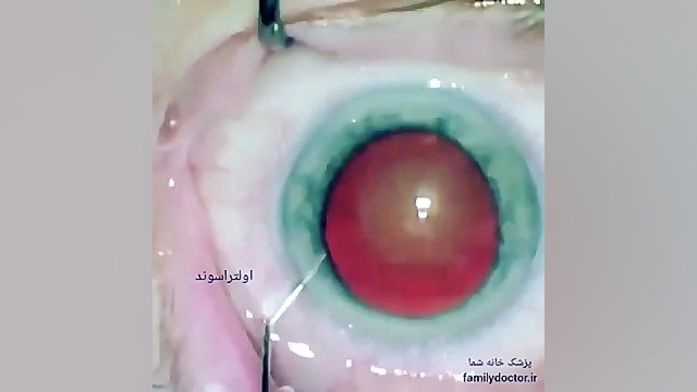 عمل جراحی آب مروارید (کاتاراکت) تزریق چربی