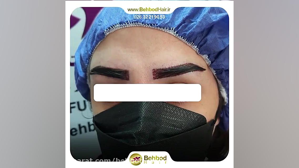 نمای نزدیک از کاشت ابرو در کلینیک کاشت موی بهبد کرج هموکروماتوز