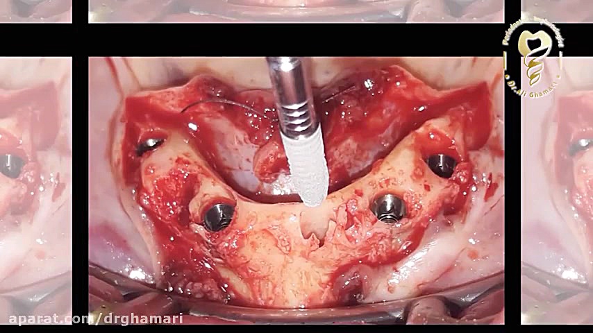 فیلم واقعی ایمپلنت ۵ دندان فک پایین همراه با بازسازی استخوان دکتر علی قمری - متخصص جراحی لثه و ایمپلنت
