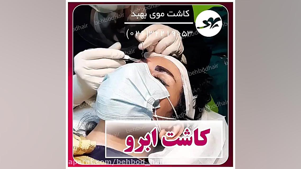 فیلم اتاق عمل کاشت ابرو بدون بیهوشی در کرج زوترلینیب