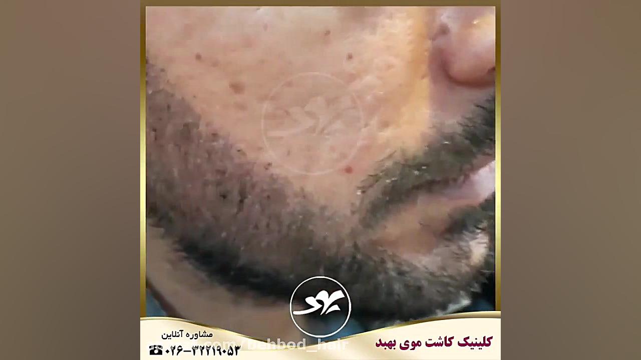کاشت ریش با بهترین روش کاشت مو در کلینیک بهبد بیماری کارنی تین ناقل نقص اولیه