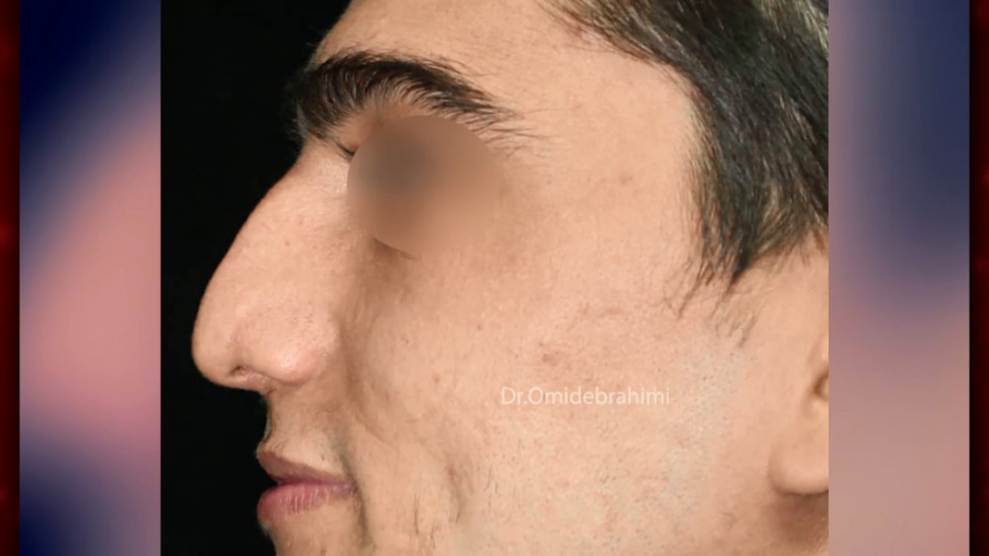 جراحی بینی طبیعی مردانه توسط دکتر امید ابراهیمی بهترین جراح بینی در تهران دکتر امید ابراهیمی