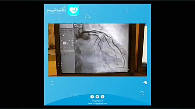 استاتین ها پیلینگ شیمیایی