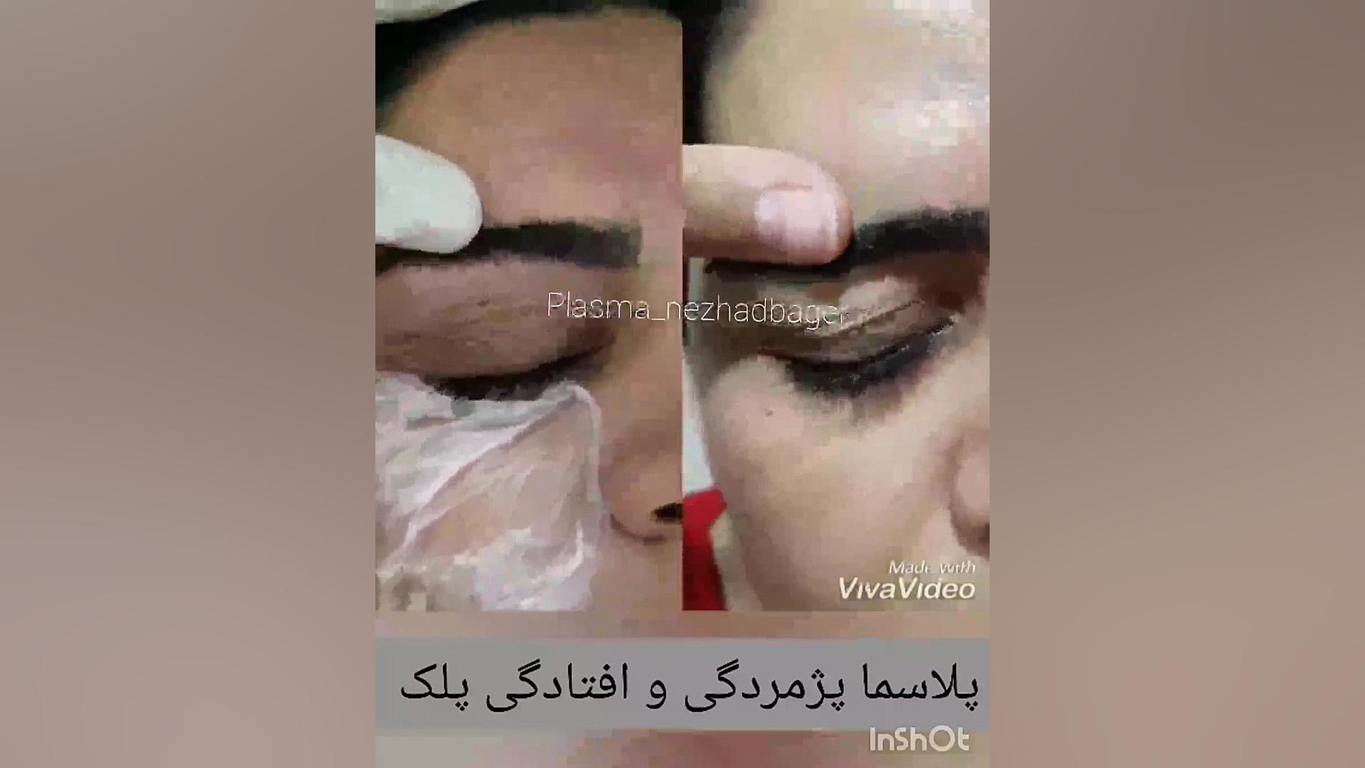 پلاسماتراپی رفع افتادگی پلک بدون جراحی❌❌❌ ان트ريكتینیب