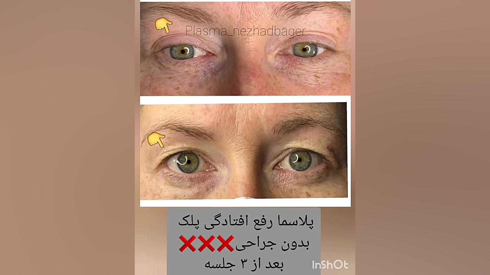 پلاسما افتادگی پلک بدون جراحی❌❌ ASO Test