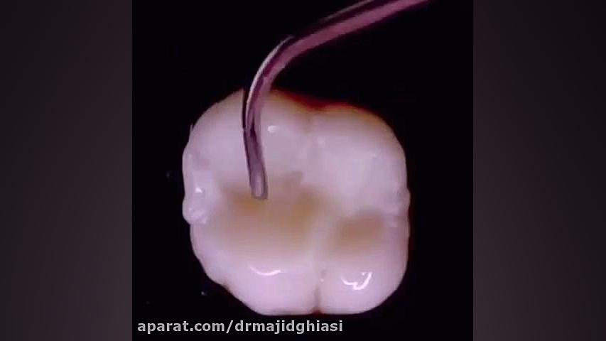 ترمیم روکش دندان بیماری کاوازاکی