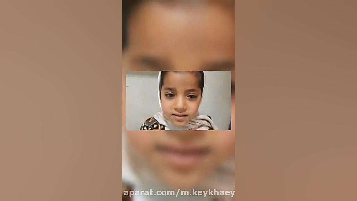 موارد اورژانسی چشم پزشکی ، ضربه به چشم، دکتر میثم سرگزی مایکروگناتیا