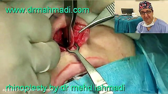 عمل زیبایی بینی(rhinoplasty)توسط متخصص گوش وحلق بینی8 دکتر مهدی احمدی