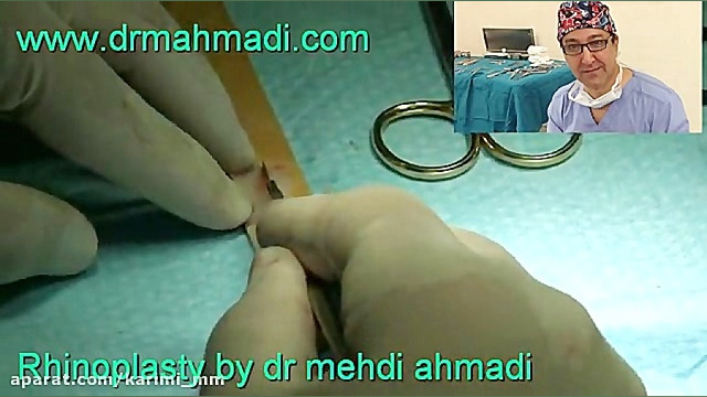 عمل زیبایی بینی(rhinoplasty)توسط متخصص گوش وحلق بینی20 دکتر مهدی احمدی