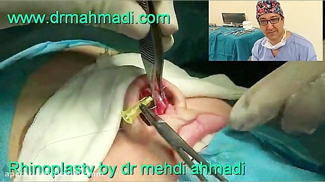 عمل زیبایی بینی(rhinoplasty)توسط متخصص گوش وحلق بینی21 دکتر مهدی احمدی