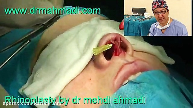 عمل زیبایی بینی(rhinoplasty)توسط متخصص گوش وحلق بینی22 دکتر مهدی احمدی
