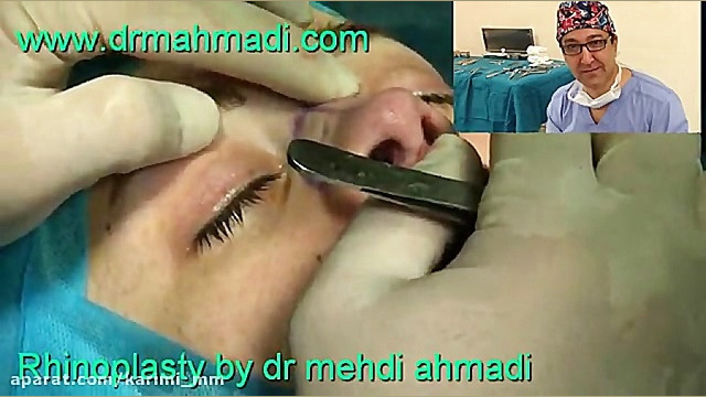 عمل زیبایی بینی(rhinoplasty)توسط متخصص گوش وحلق بینی23 دکتر مهدی احمدی
