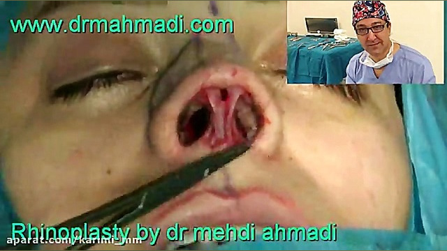 عمل زیبایی بینی(rhinoplasty)توسط متخصص گوش وحلق بینی24 دکتر مهدی احمدی