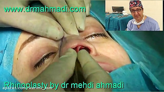 عمل زیبایی بینی(rhinoplasty)توسط متخصص گوش وحلق بینی25 دکتر مهدی احمدی