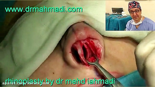 عمل زیبایی بینی(rhinoplasty)توسط متخصص گوش وحلق بینی13 دکتر مهدی احمدی