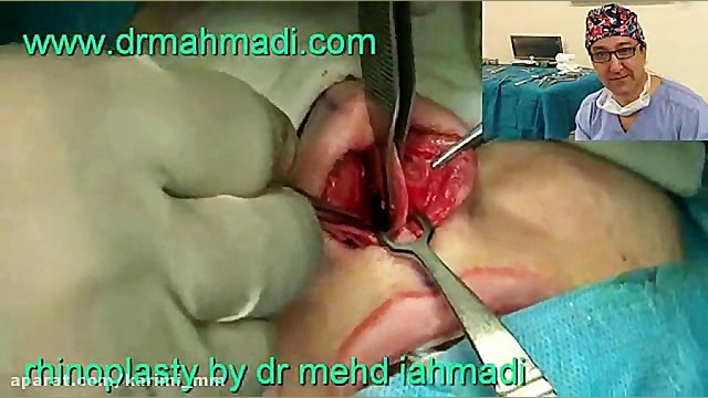 عمل زیبایی بینی(rhinoplasty)توسط متخصص گوش وحلق بینی12 دکتر مهدی احمدی
