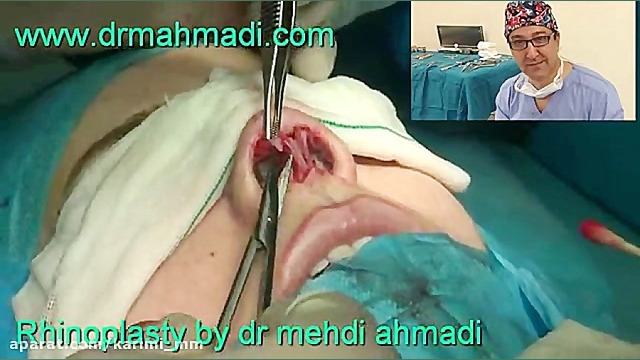 عمل زیبایی بینی(rhinoplasty)توسط متخصص گوش وحلق بینی27 دکتر مهدی احمدی