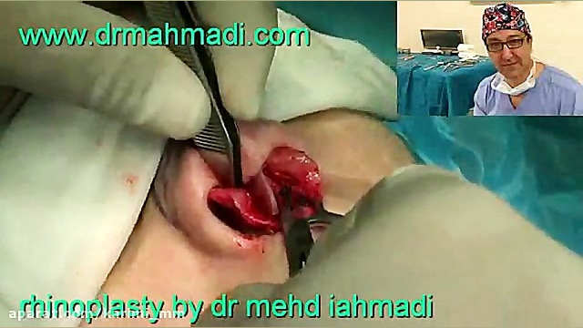 عمل زیبایی بینی(rhinoplasty)توسط متخصص گوش وحلق بینی14 دکتر مهدی احمدی