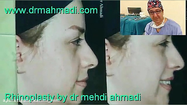 عمل زیبایی بینی(rhinoplasty)توسط متخصص گوش وحلق بینی28 دکتر مهدی احمدی