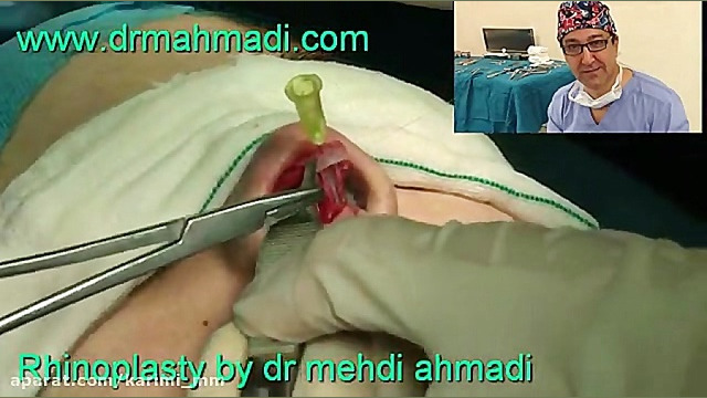 عمل زیبایی بینی(rhinoplasty)توسط متخصص گوش وحلق بینی31 دکتر مهدی احمدی