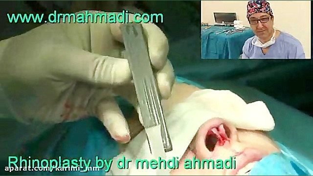عمل زیبایی بینی(rhinoplasty)توسط متخصص گوش وحلق بینی16 دکتر مهدی احمدی