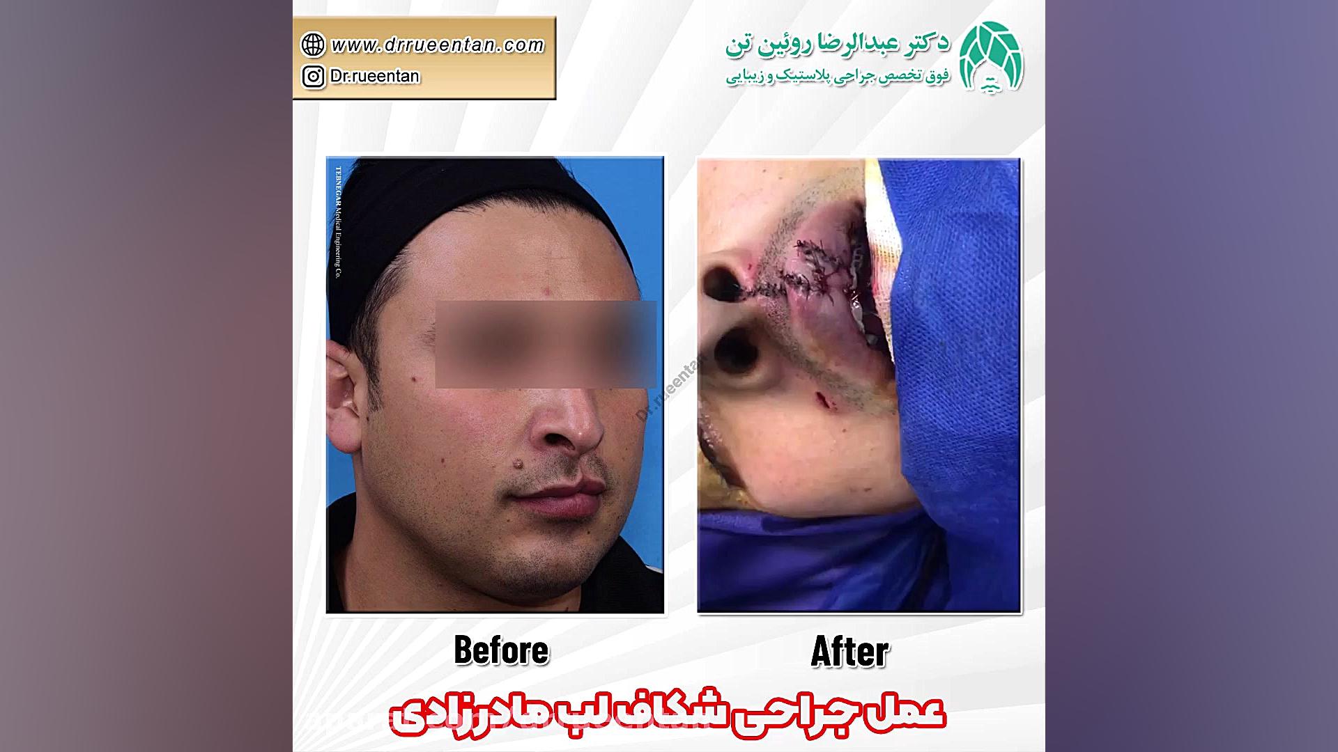 جراحی شکاف لب مادرزادی | فوق تخصص جراحی پلاستیک | دکتر عبدالرضا روئین تن دکتر عبدالرضا روئین تن