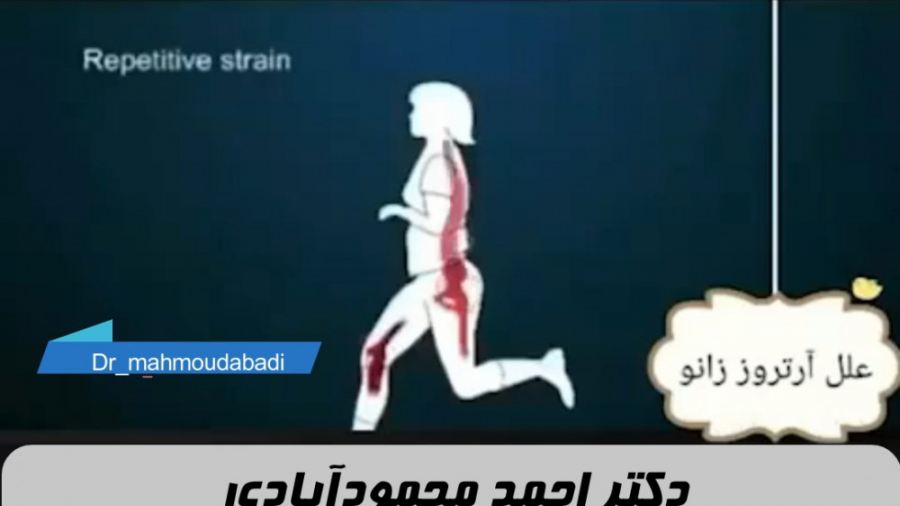 آرتروز زانو دکتر احمد محمودابادی