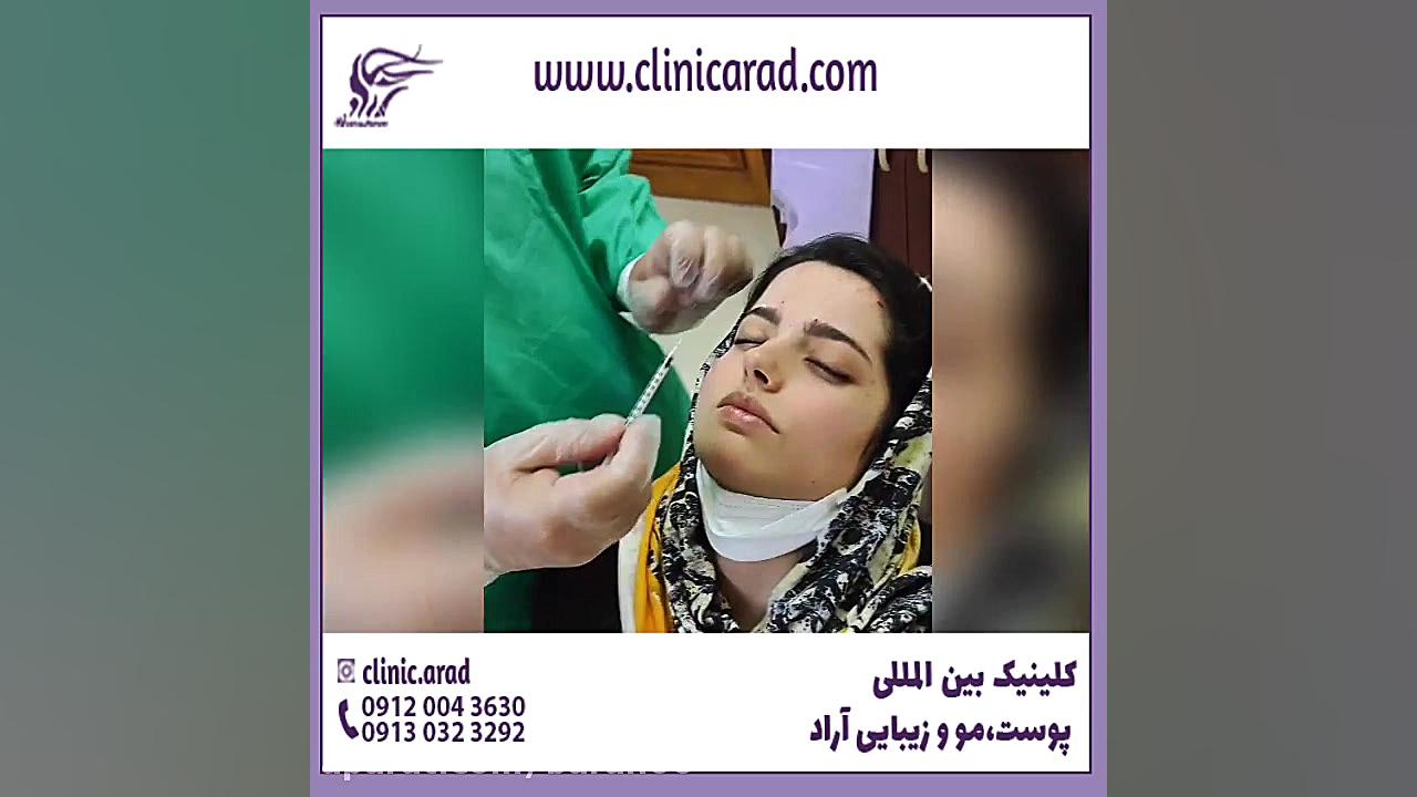تزریق ژل برای صورت لاغر چگونه انجام میشود؟ کاتاپلکسی