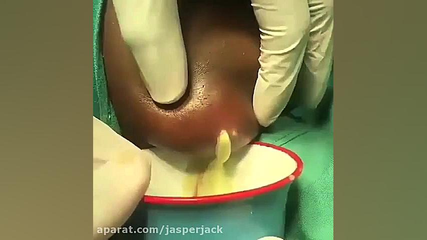 تخلیه کیست عفونی ( لطفا اگر بد دلید نبینید که توهین نشه ) بررسی لک صورت