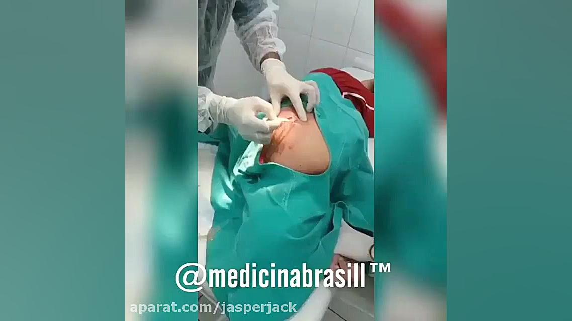 تخلیه کیست عفونی ( لطفا اگر بد دلید نبینید که توهین نشه ) لمینت
